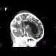 Meningencephalitis, abscessing: CT - Computed tomography